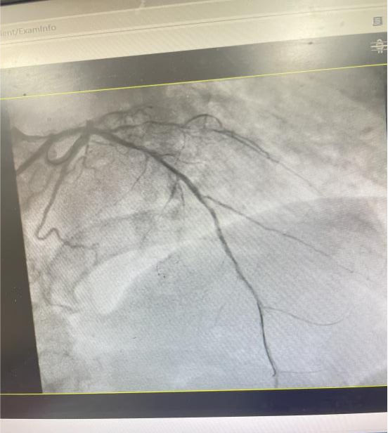 前降支中段血管开通