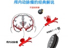 神经外科系列科普丨颅内动脉瘤的预防和治疗