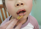 鱼钩飞入口中 女童嘴唇被“咬”！佛冈人医医生提醒：千万别硬拉