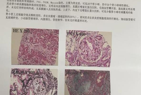 健康科普丨肾穿刺？肾活检？佛冈人医带你了解肾脏病诊断“金标准”