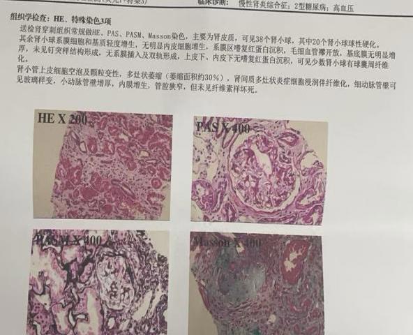 健康科普丨肾穿刺？肾活检？佛冈人医带你了解肾脏病诊断“金标准”