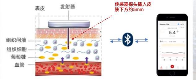 告别天天扎手指！动态血糖监测了解一下